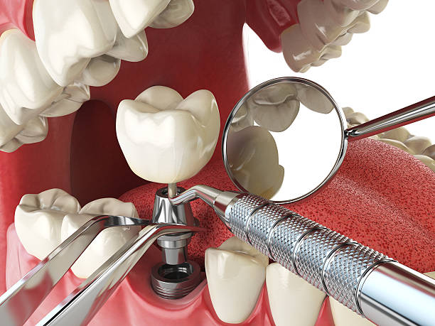 Best Emergency Tooth Extraction in Ashley, OH
